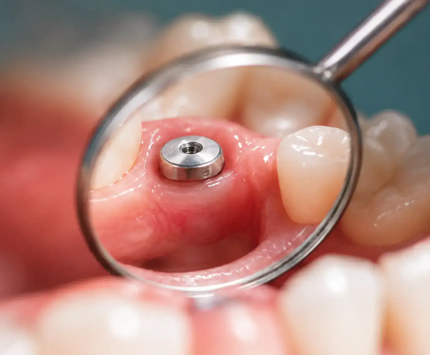 Osteointegracja — wszczepiony implant zrośnięty z kością, kontrola w lusterku